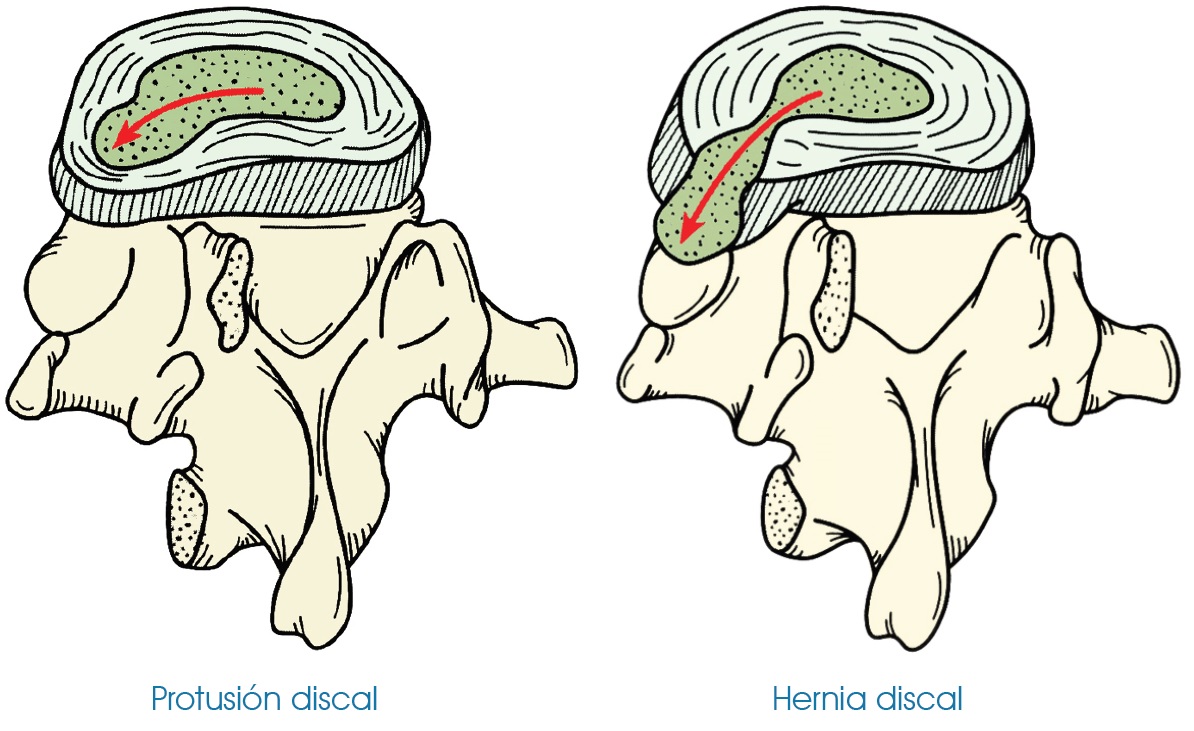 Hernia discal